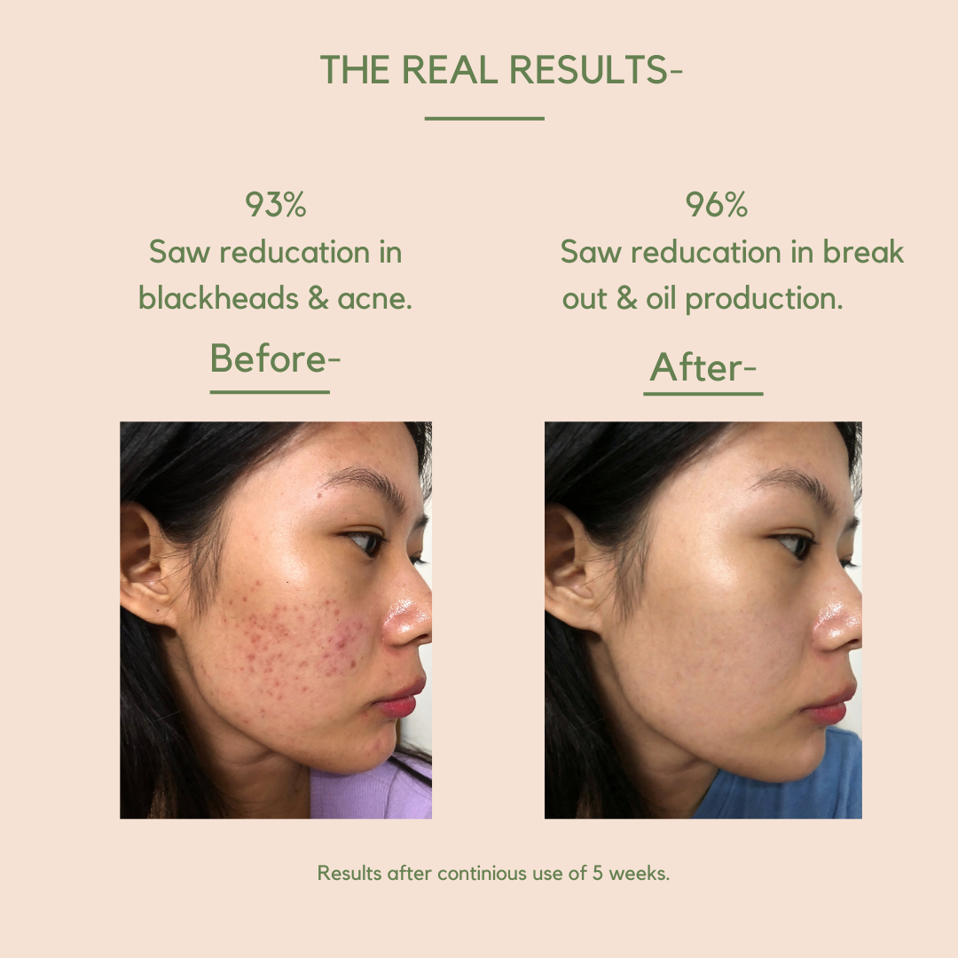 Salicylic acid 2% + niacinamide 5% with Tea tree hydrosol & face serum