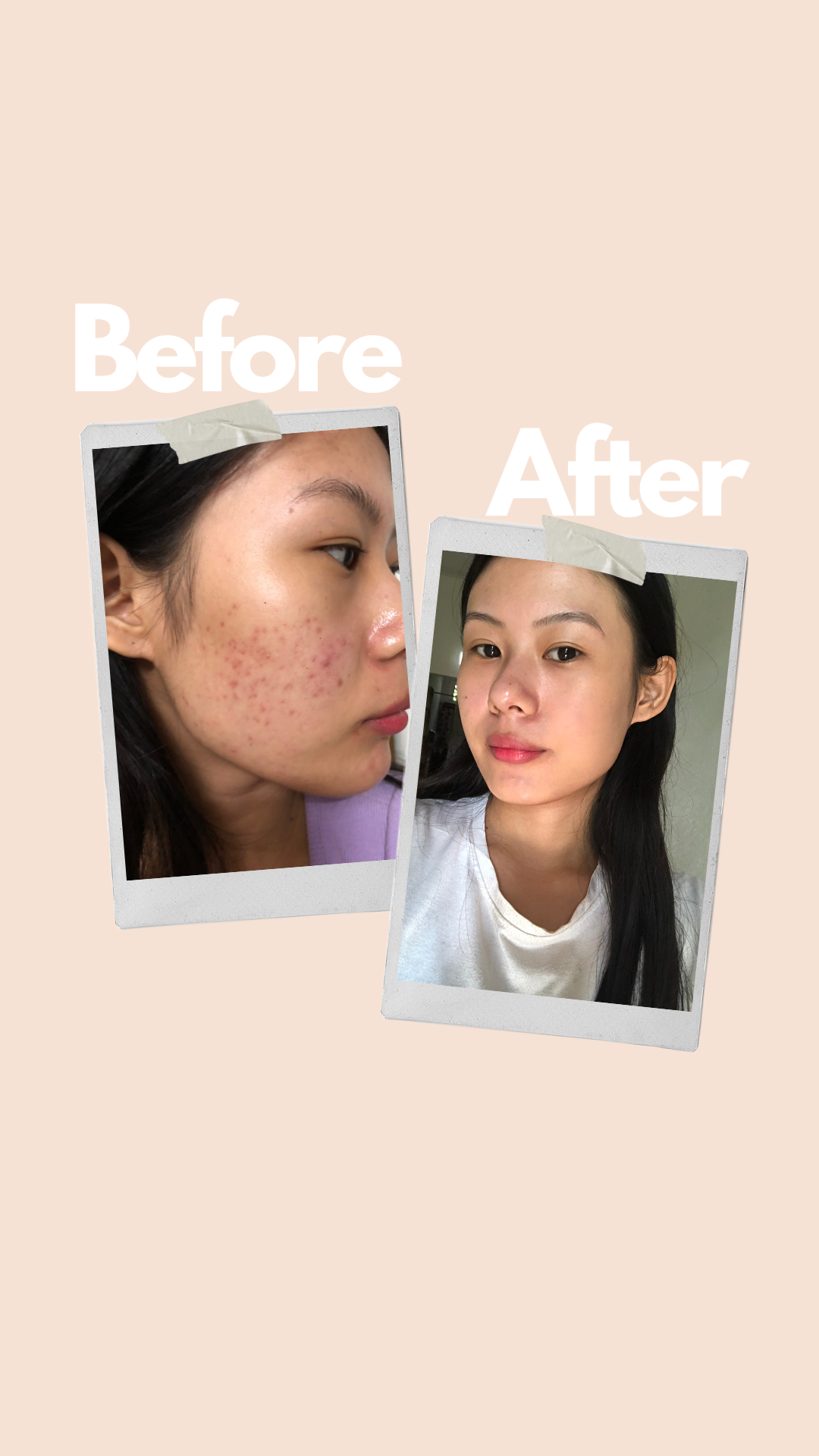 Salicylic acid 2% + niacinamide 5% with Tea tree hydrosol & face serum